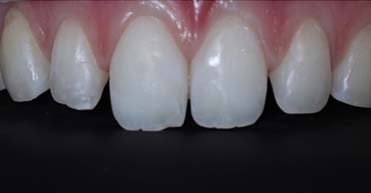 Before - Nuvo Dental Implant Centre