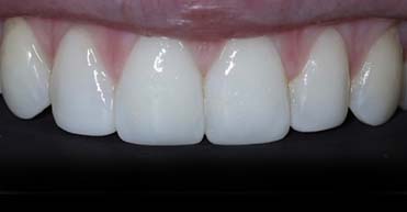 After - Nuvo Dental Implant Centre