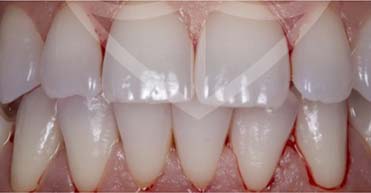 After - Nuvo Dental Implant Centre