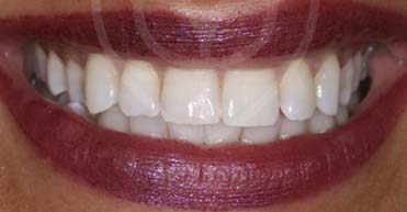 After - Nuvo Dental Implant Centre