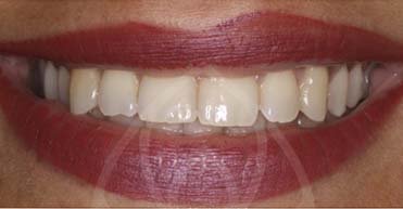 Before - Nuvo Dental Implant Centre