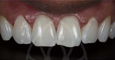 Before - Nuvo Dental Implant Centre