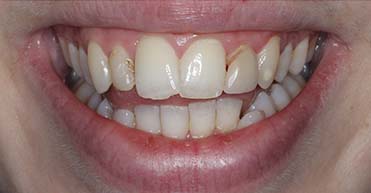 Before - Nuvo Dental Implant Centre