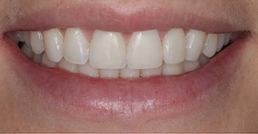 After - Nuvo Dental Implant Centre