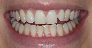 Before - Nuvo Dental Implant Centre