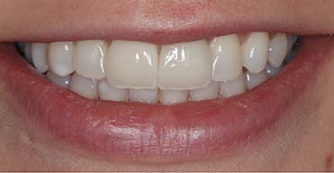 After - Nuvo Dental Implant Centre