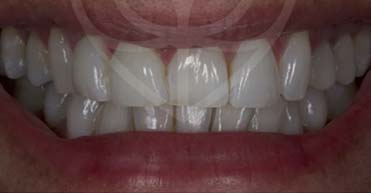 After - Nuvo Dental Implant Centre