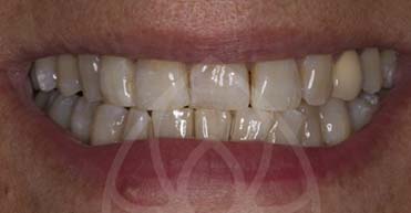 Before - Nuvo Dental Implant Centre