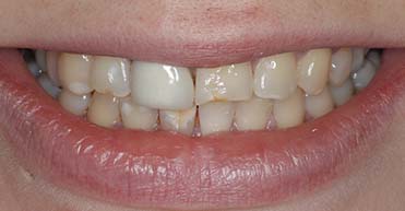 Before - Nuvo Dental Implant Centre